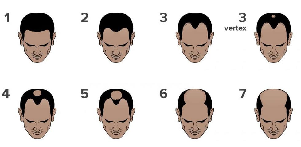 The Norwood Scale - the levels of male pattern baldness