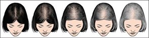 The Ludwig Scale of female hair loss